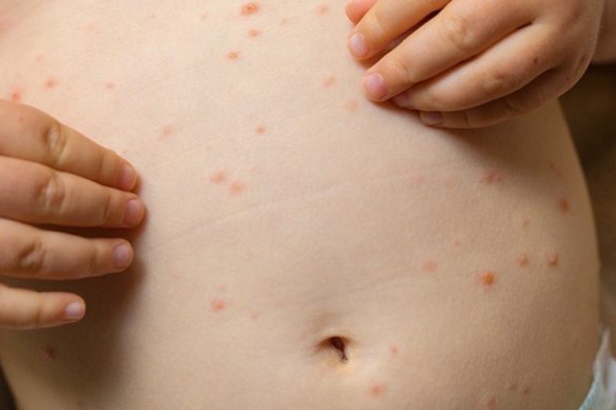 OMS afirma que casos de sarampo triplicaram em 2019