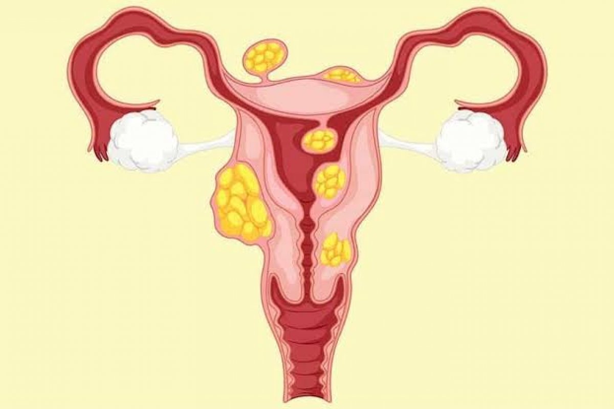 Miomas podem atingir até metade das mulheres e causar infertilidade se não tratados corretamente