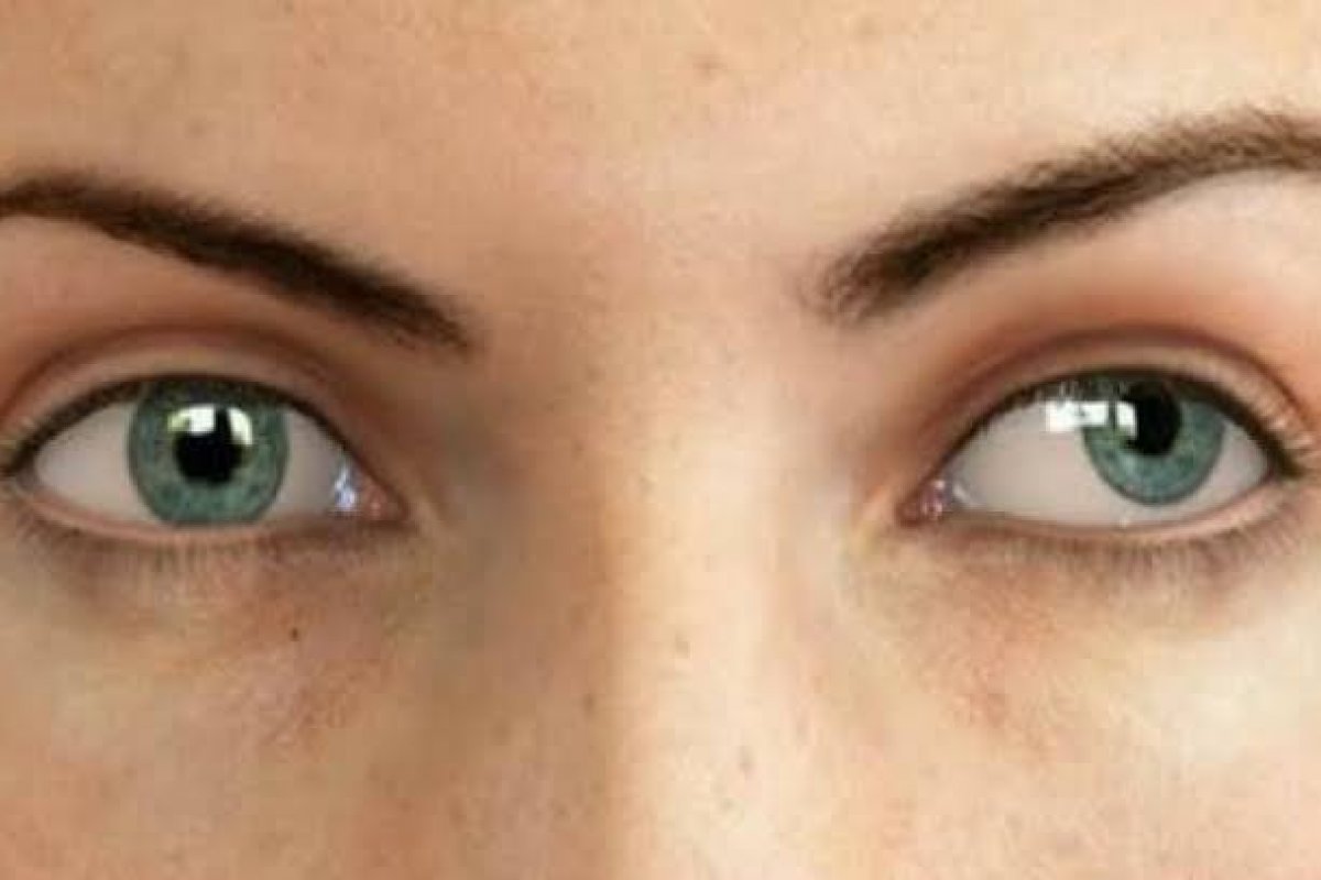 Tudo que você precisa saber sobre o estrabismo convergente