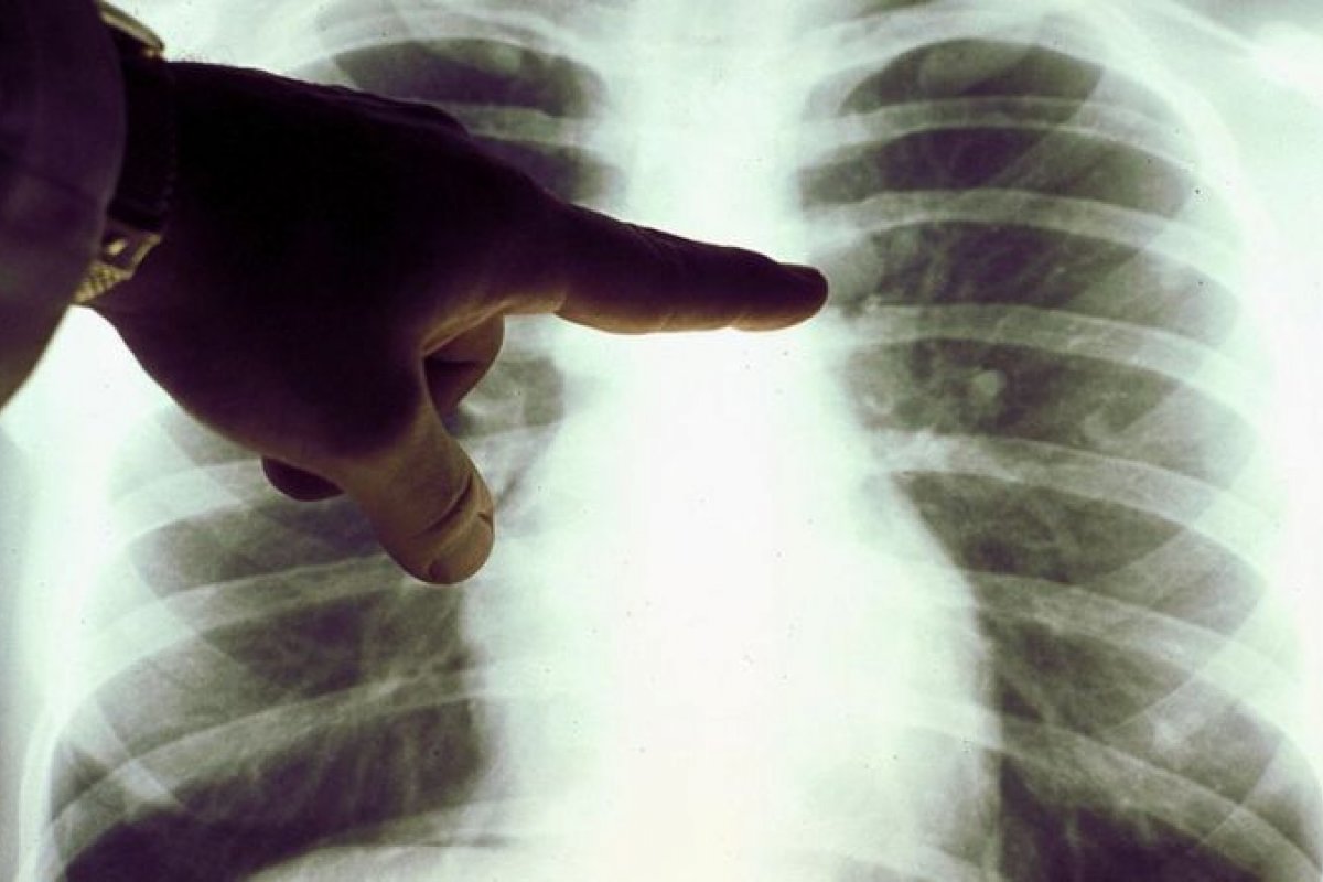 Homem se cura de linfoma após infecção por Covid-19