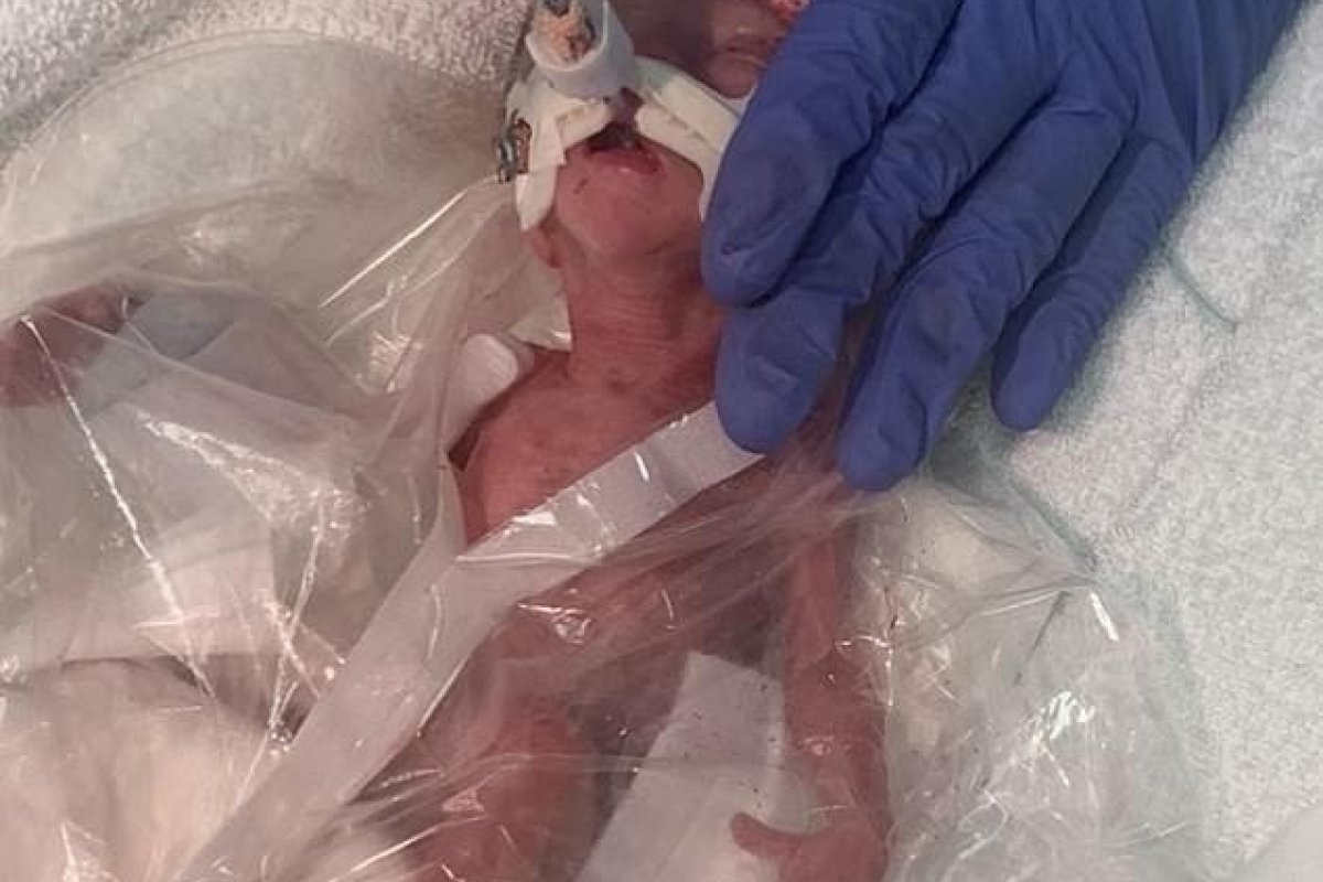 Saco de sanduíche é usado para manter temperatura corporal de prematuro de 490 gramas 