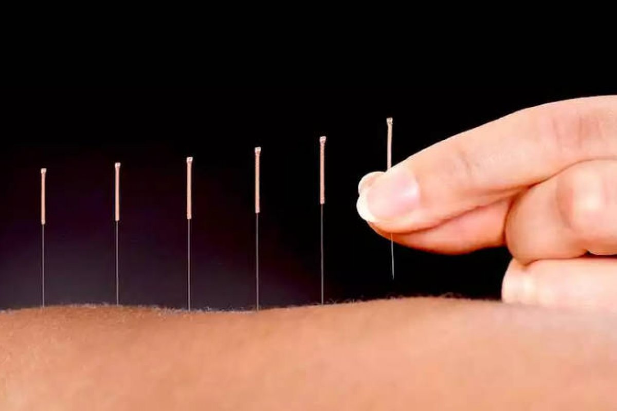 Projeto que regulamenta a acupuntura é aprovado por comissão da Câmara