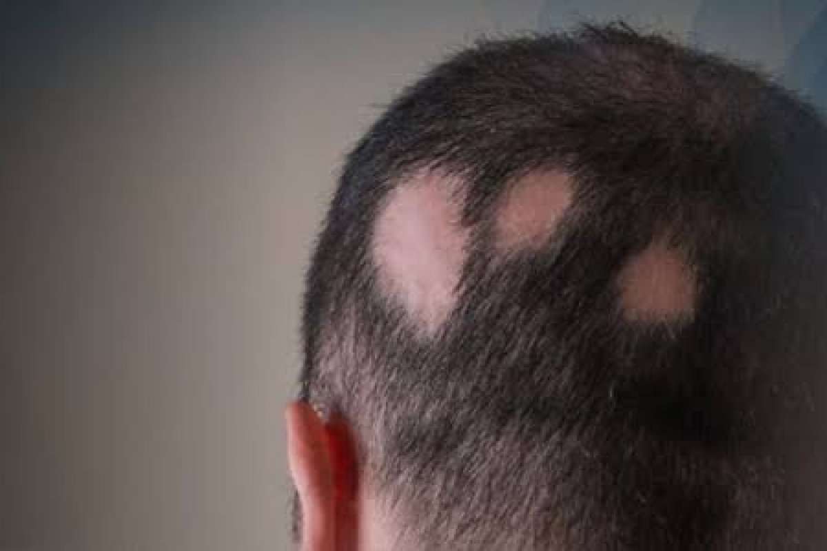 Alopecia: Descubra as principais causas e como tratar