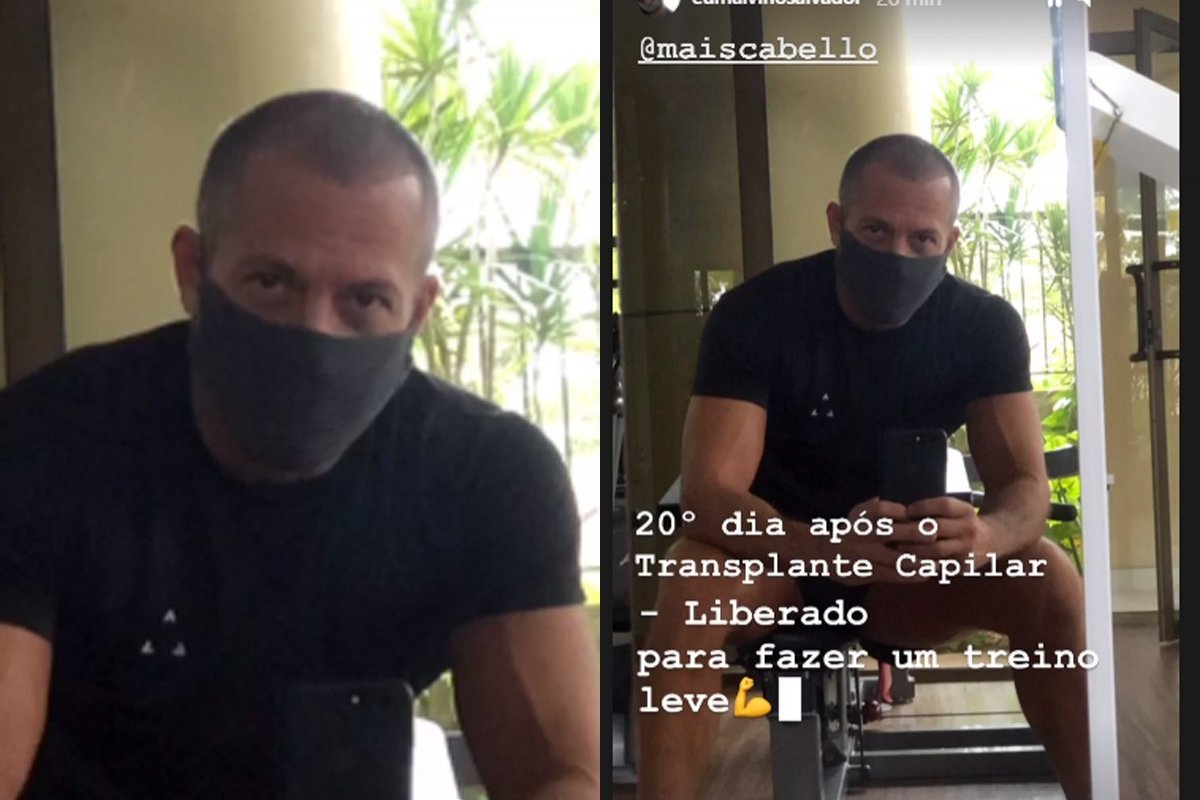Malvino Salvador passa por transplante capilar e mostra o resultado