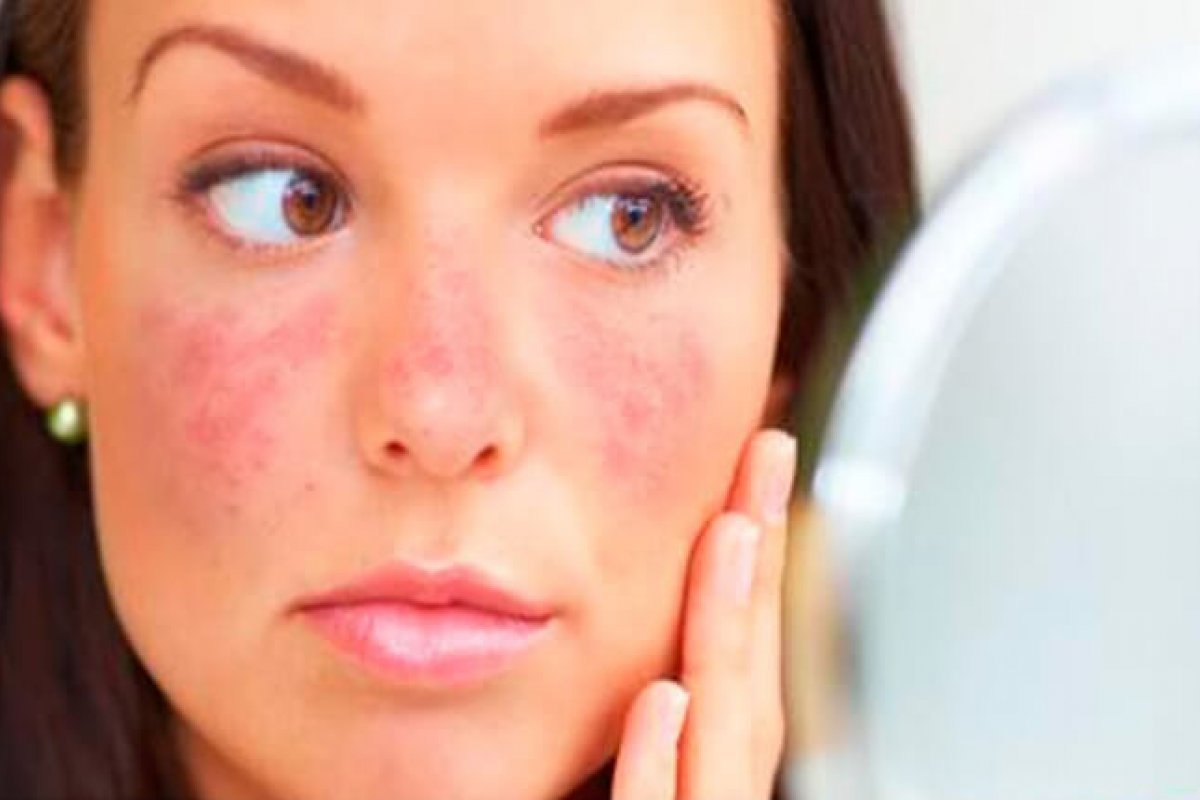 A história do Lúpus: uma doença ainda carregada de preconceitos e pouco conhecimento