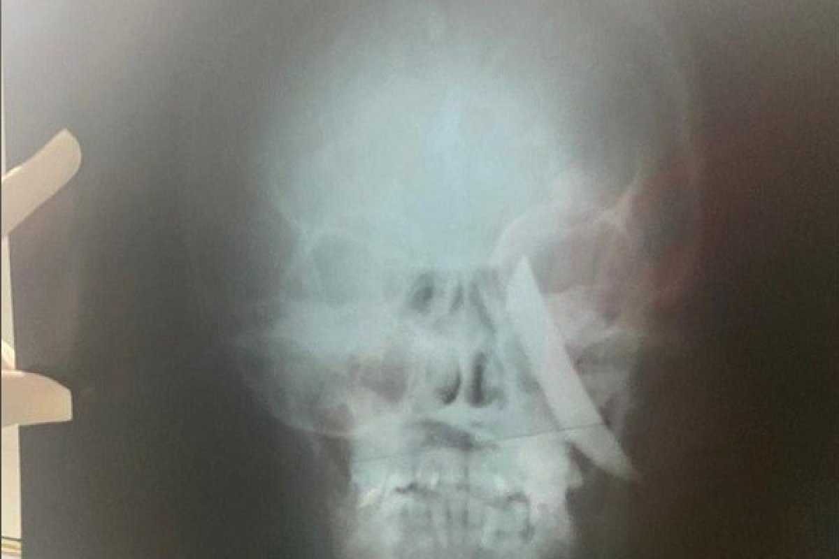 Mulher fica com uma faca cravada no crânio após tentativa de feminicidio