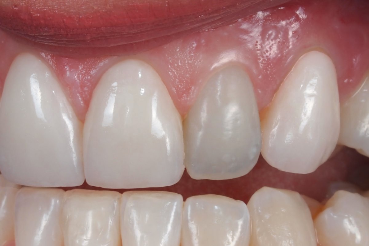 Saiba como cuidar dos seus dentes para evitar o escurecimento dentário