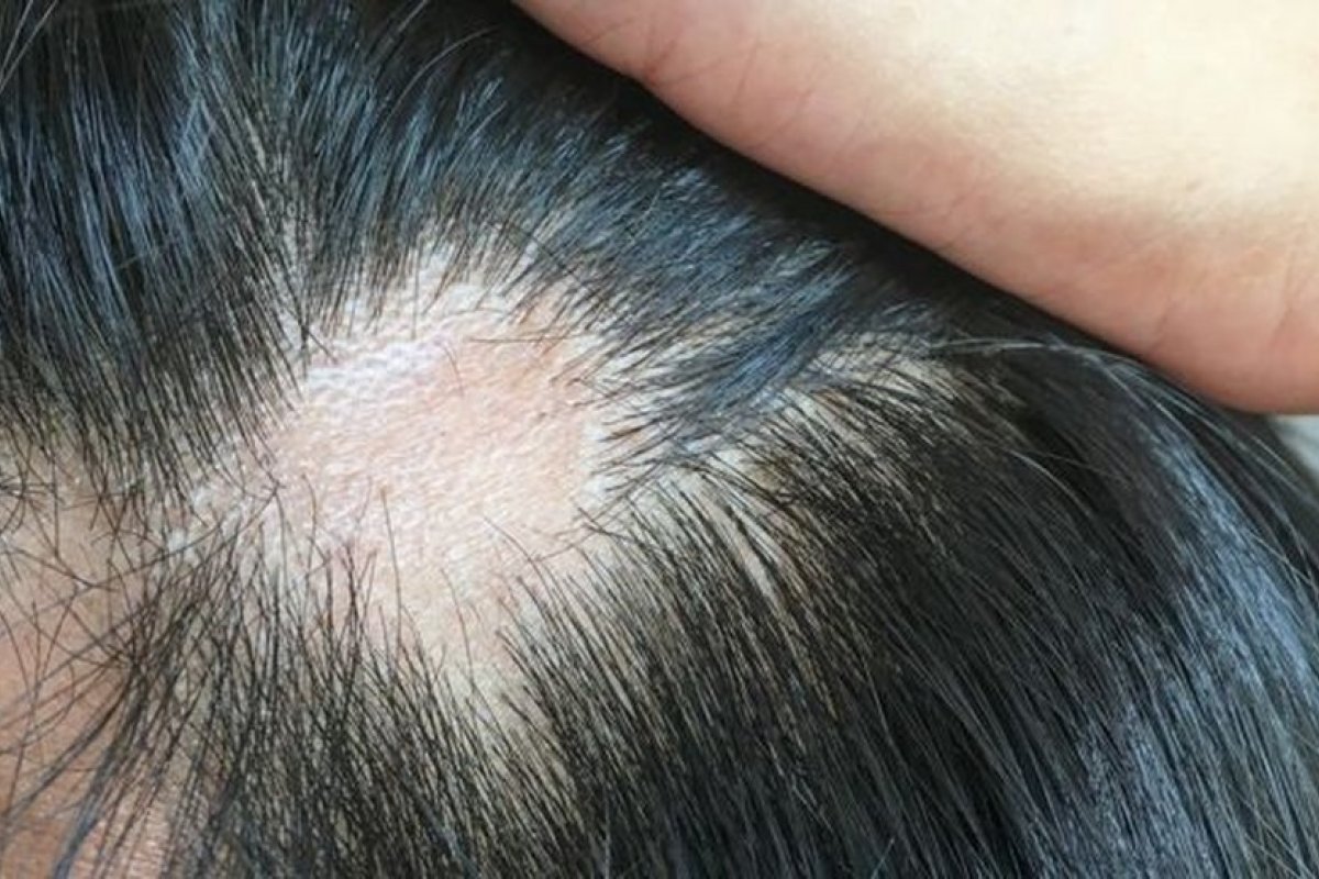 Queda de cabelo afeta 1 em 4 infectados por Covid-19