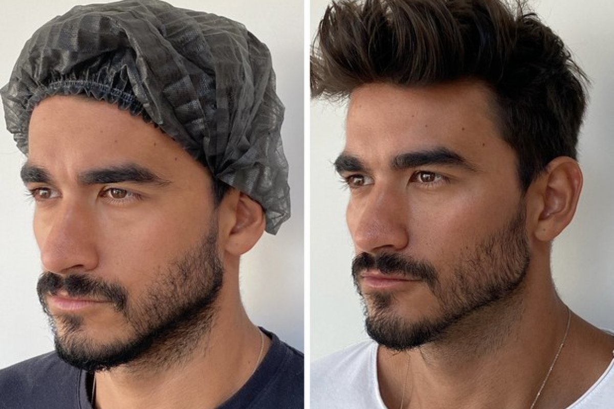 Novo visual! Ex-BBB Gui Napolitano se rende a harmonização facial e ao famoso botox!