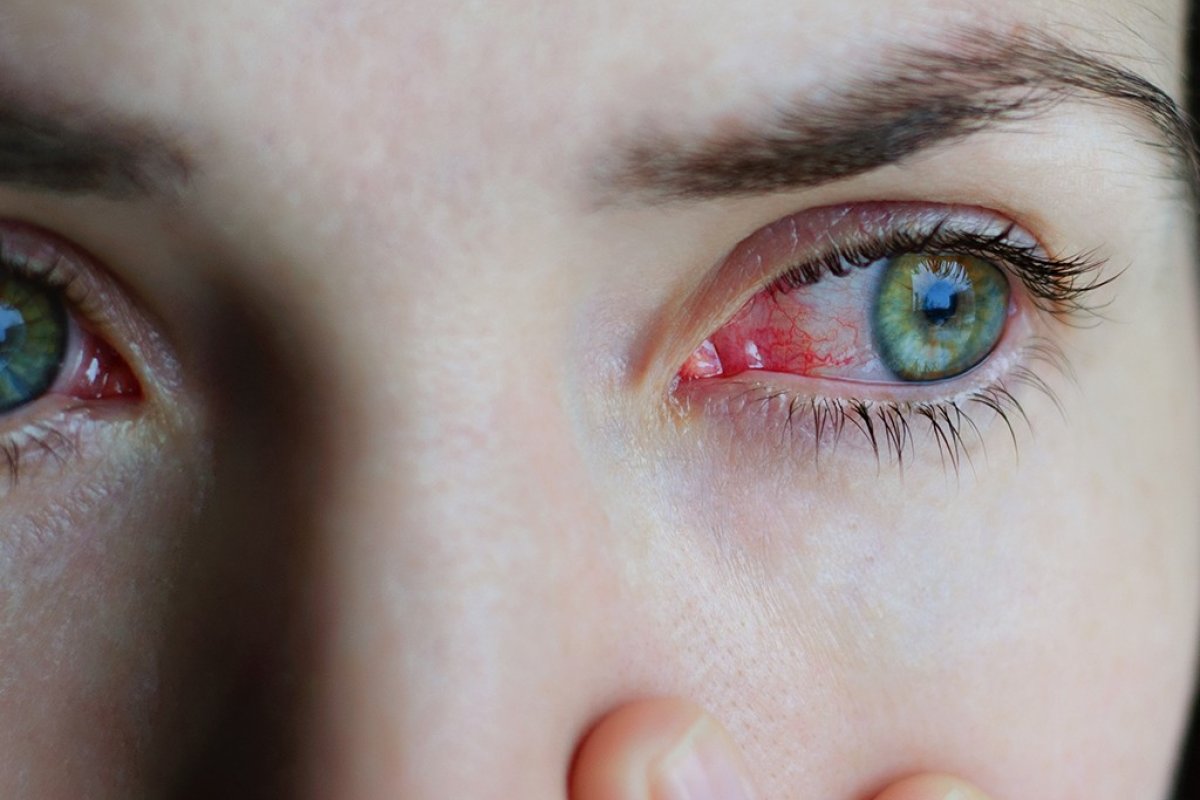 Maior parte da população ainda desconhece que conjuntivite também pode ser sintoma da Covid-19, mesmo após um ano de pandemia!