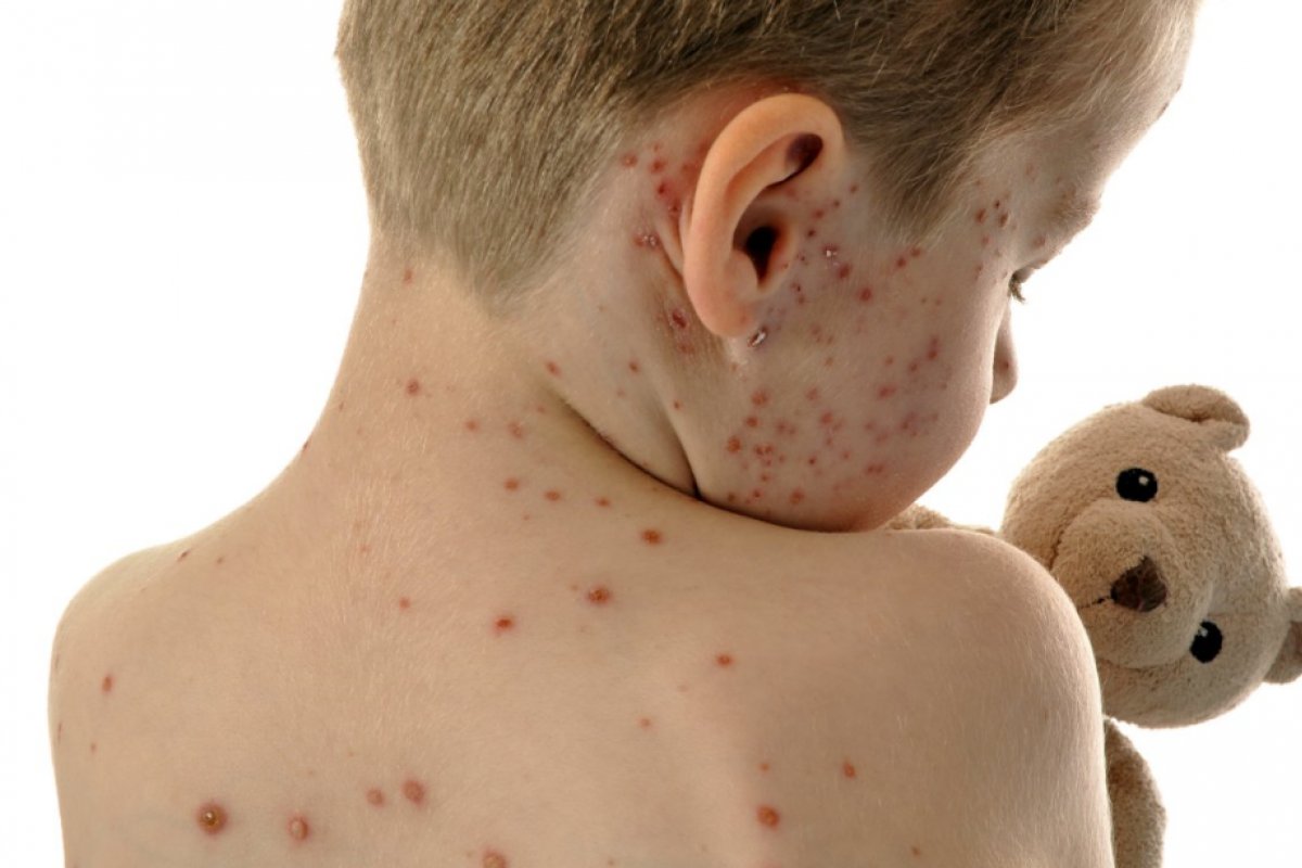 Sarampo: como descobrir e tratar a doença que voltou com tudo