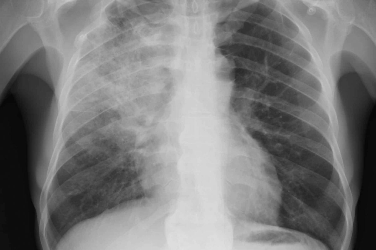 Japonesa infectada pelo coronavírus recebe transplante de pulmão de doadores vivos