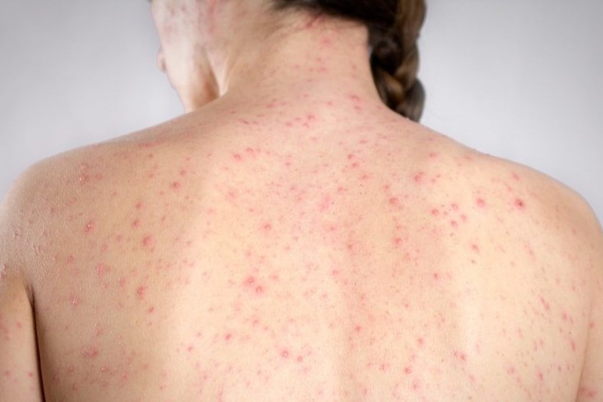 Sarampo: estados recebem doses extras da vacina tríplice viral