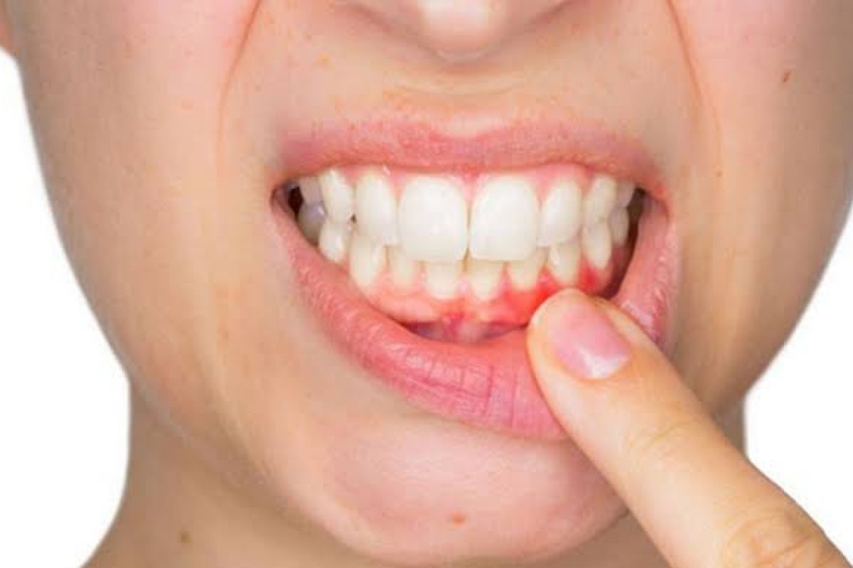 Ir ao dentista é a única forma de intervir em casos de periodontite!