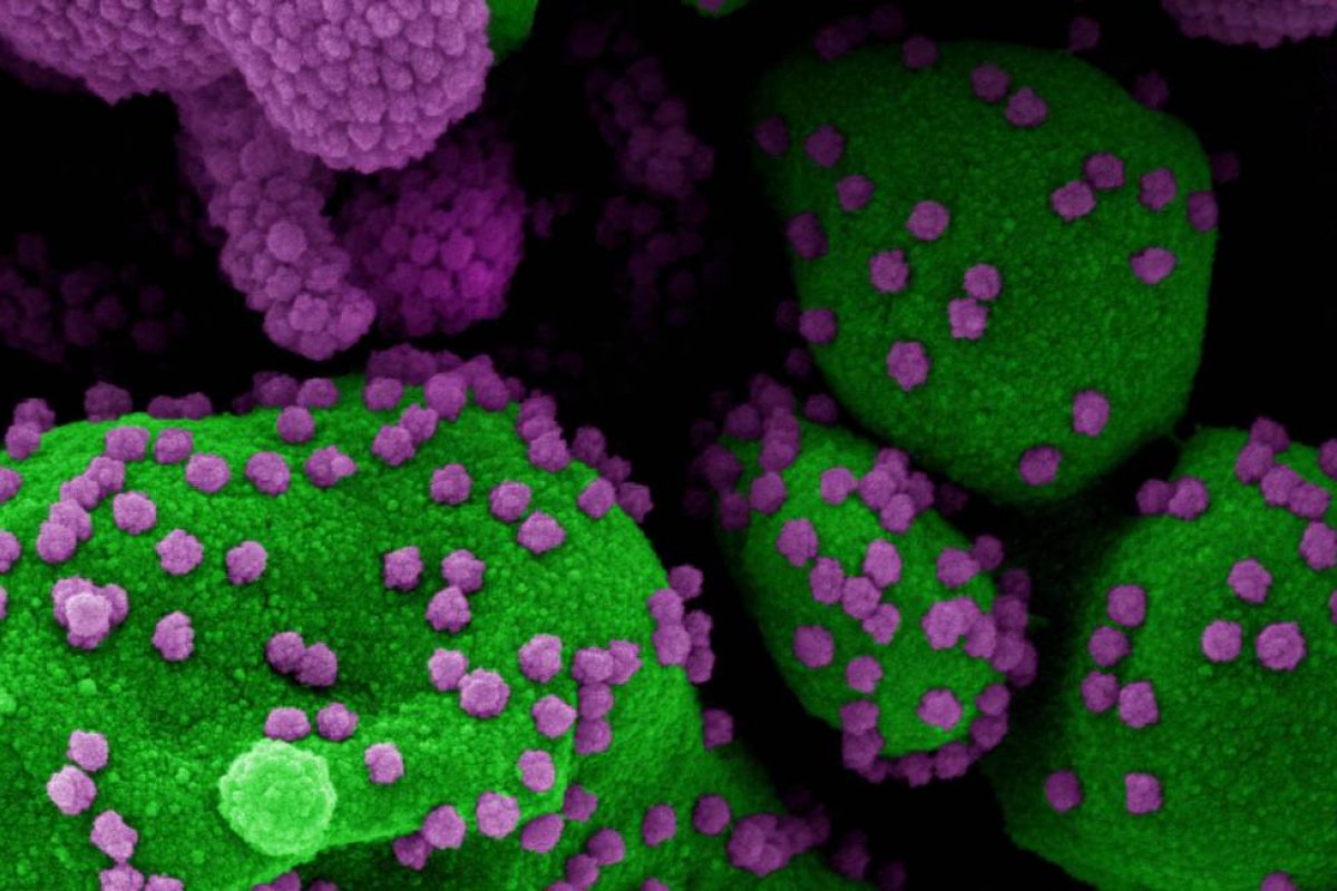 Pesquisadores brasileiros defendem que a Covid-19 seja classificada como febre viral trombótica