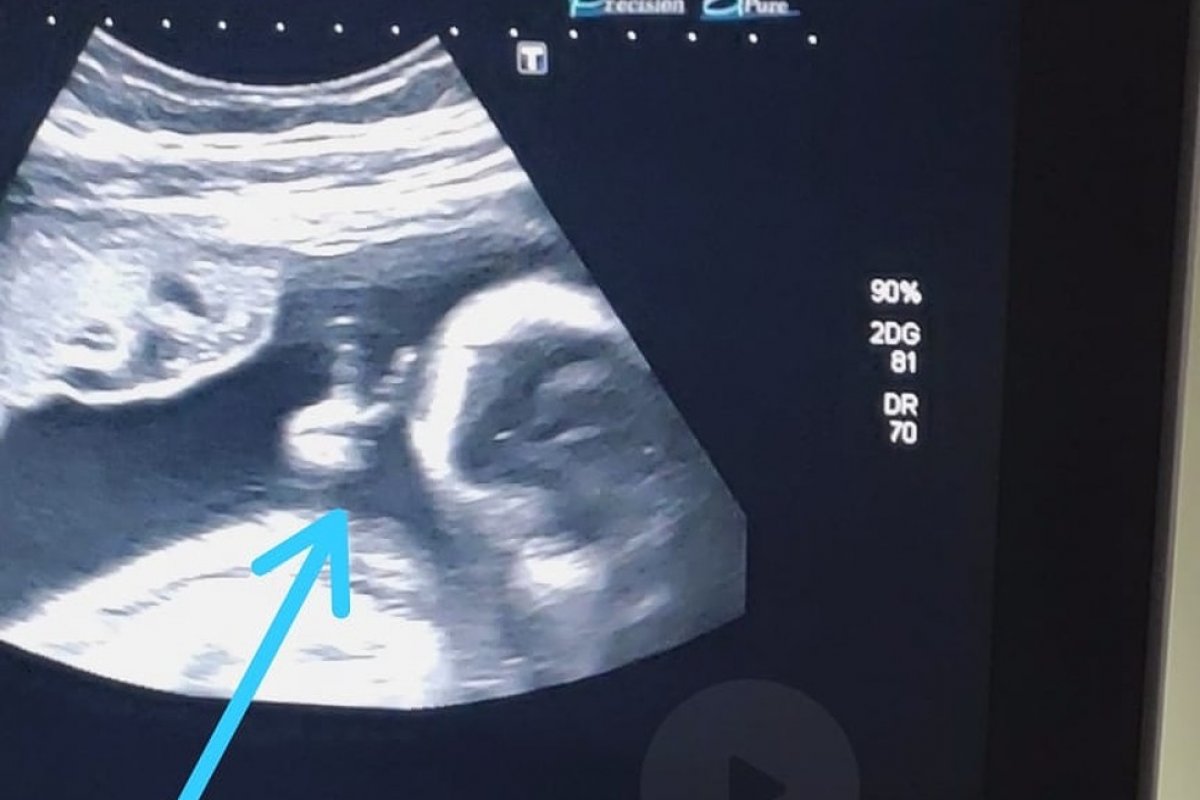 Bebê faz 'V de vitória' durante ultrassom e pai com câncer raro vê como sinal divino