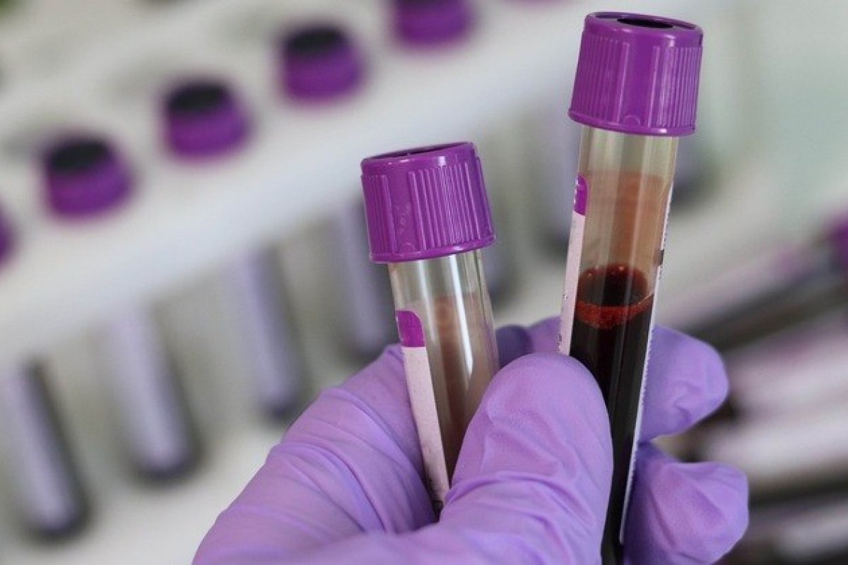 Níveis de proteína no sangue podem prever gravidade de Covid