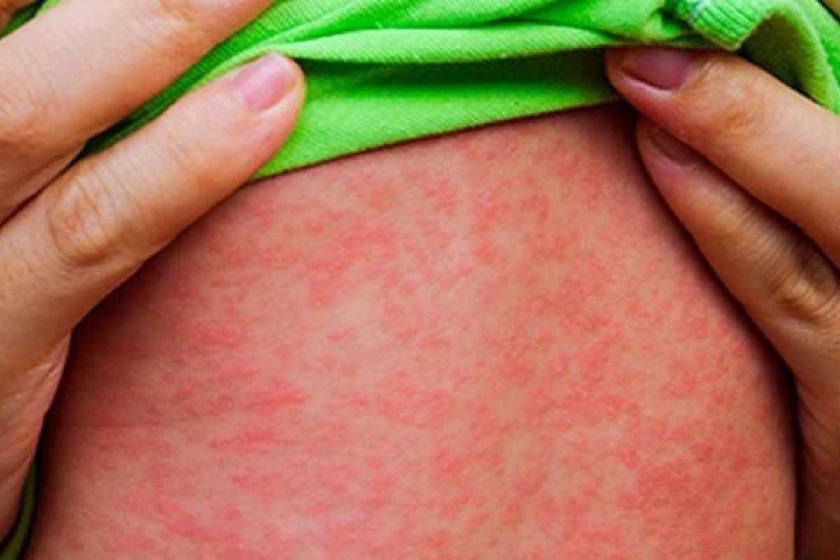 Saiba como se proteger contra o sarampo em caso de viagem
