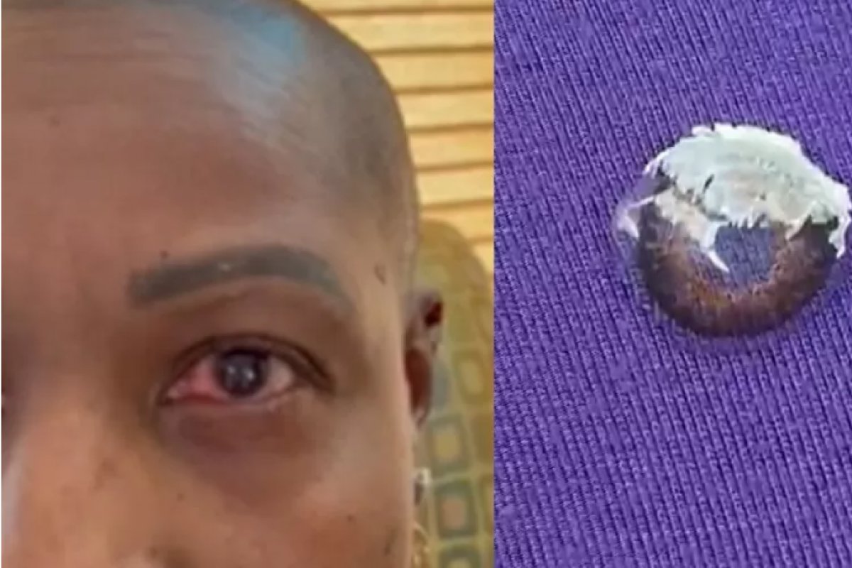 Mulher nos EUA quase perde a visão após confundir cola com colírio