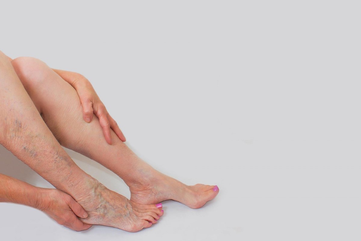 Como acabar com as varizes e vasinhos?