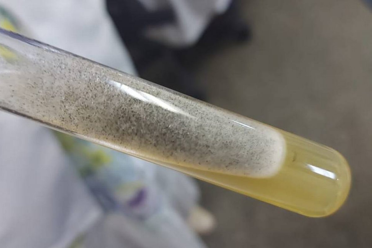 Rio Grande do Norte confirma primeiro caso do 'fungo preto'