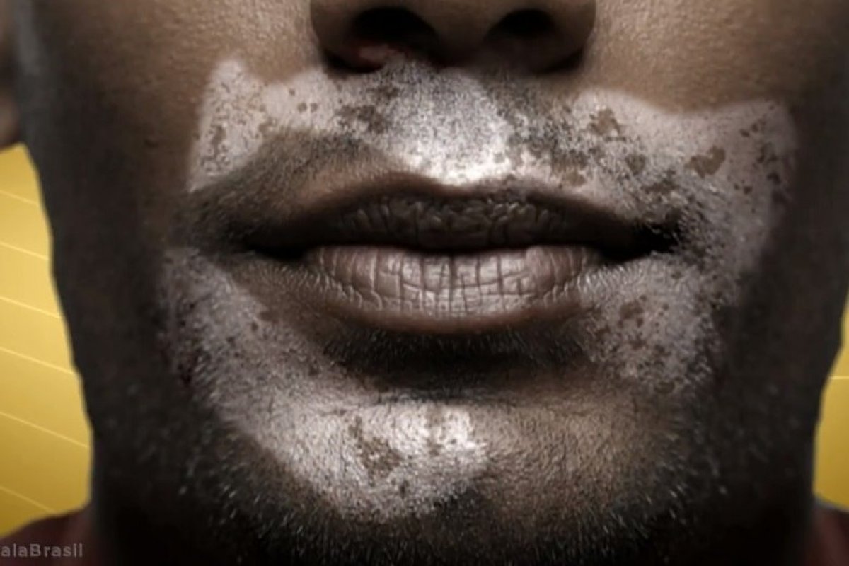 Dia Mundial do Vitiligo abre alerta para o impacto da doença na saúde mental