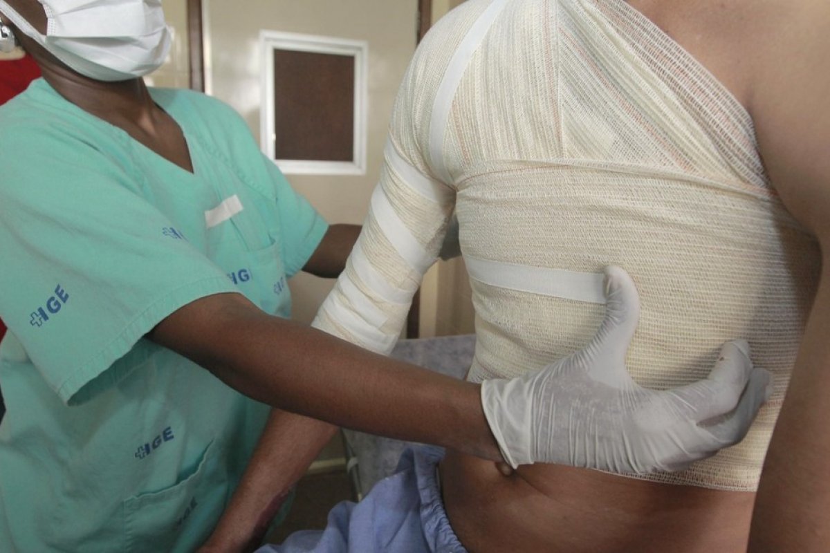 Bahia: hospital para queimados tem alta de 57% nos atendimentos no período do São João