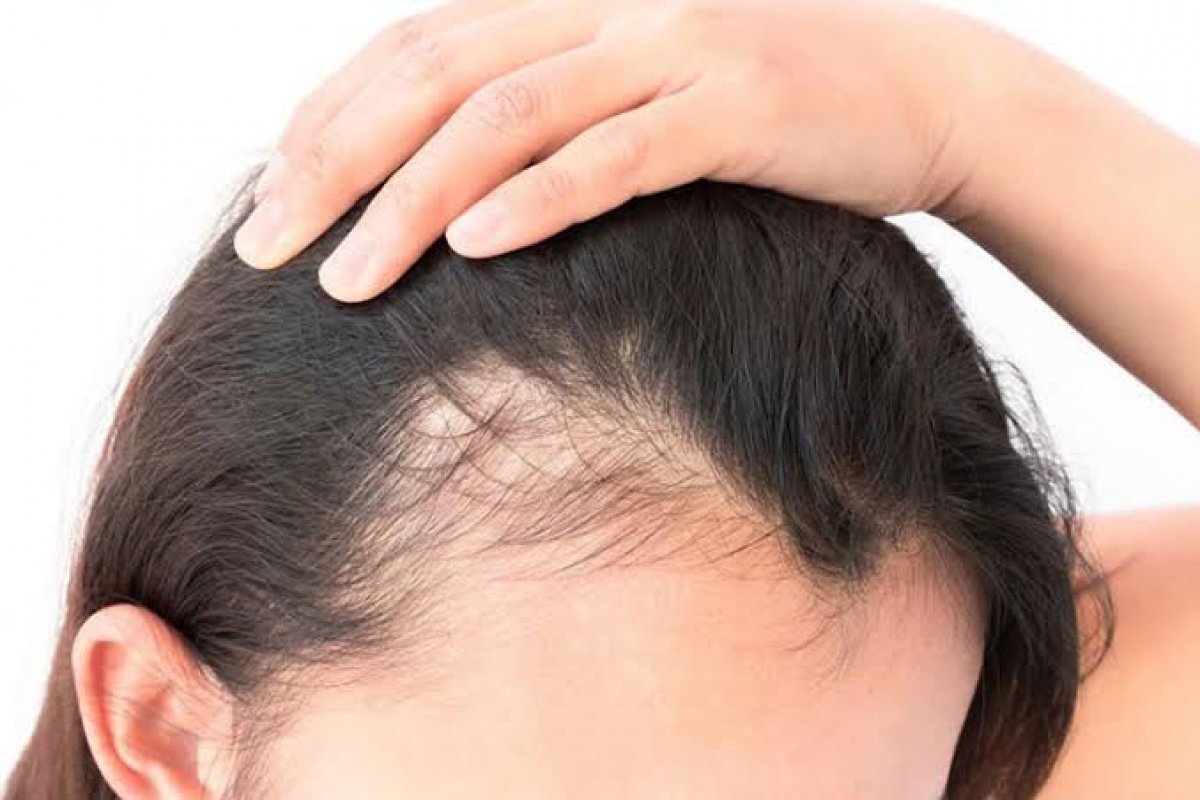 Casos de alopecia disparam na pandemia
