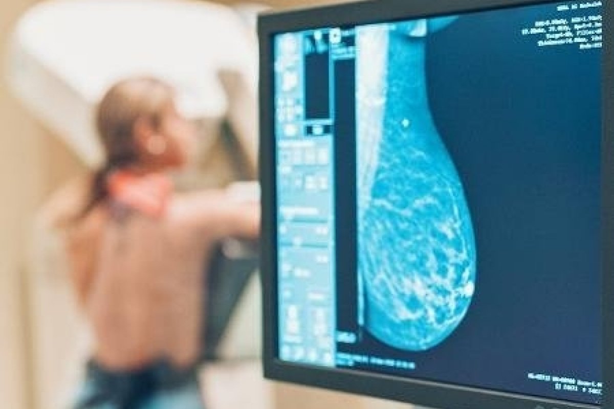 Diagnóstico de câncer de mama e colo de útero caem durante a pandemia