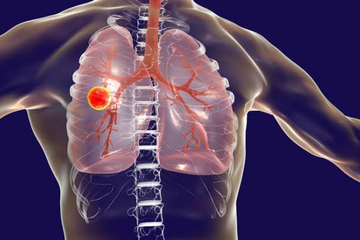 Compostos que podem combater um tipo de tuberculose é revelado em estudo