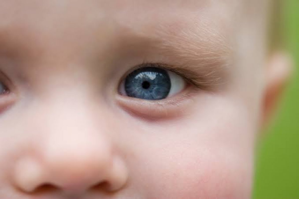 Glaucoma congênito é a principal causa de cegueira na infância