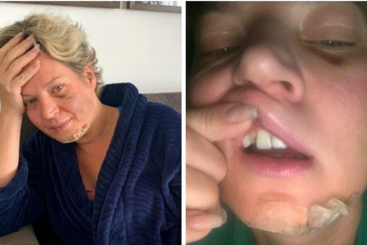 Vídeo: Com hematomas no rosto, Joice Hasselmann afirma ter sido vítima de "atentado"