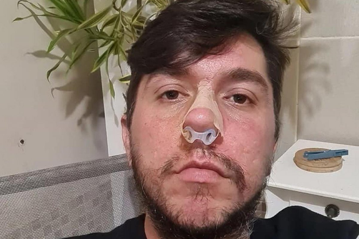 Homem perde parte do nariz após aplicação de ácido hialurônico nos lábios