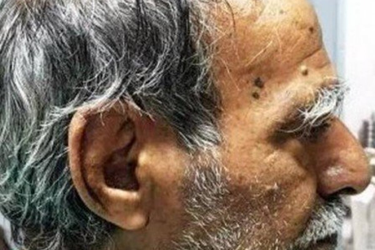 Homem de 74 anos passa por cirurgia para remover chifre