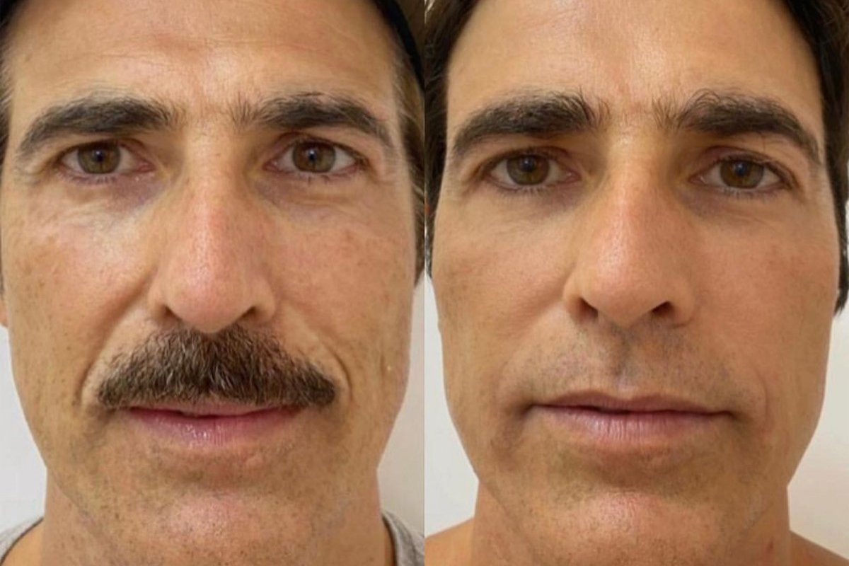 Procedimento estético garante rejuvenescimento saudável e vira tendência entre os famosos 