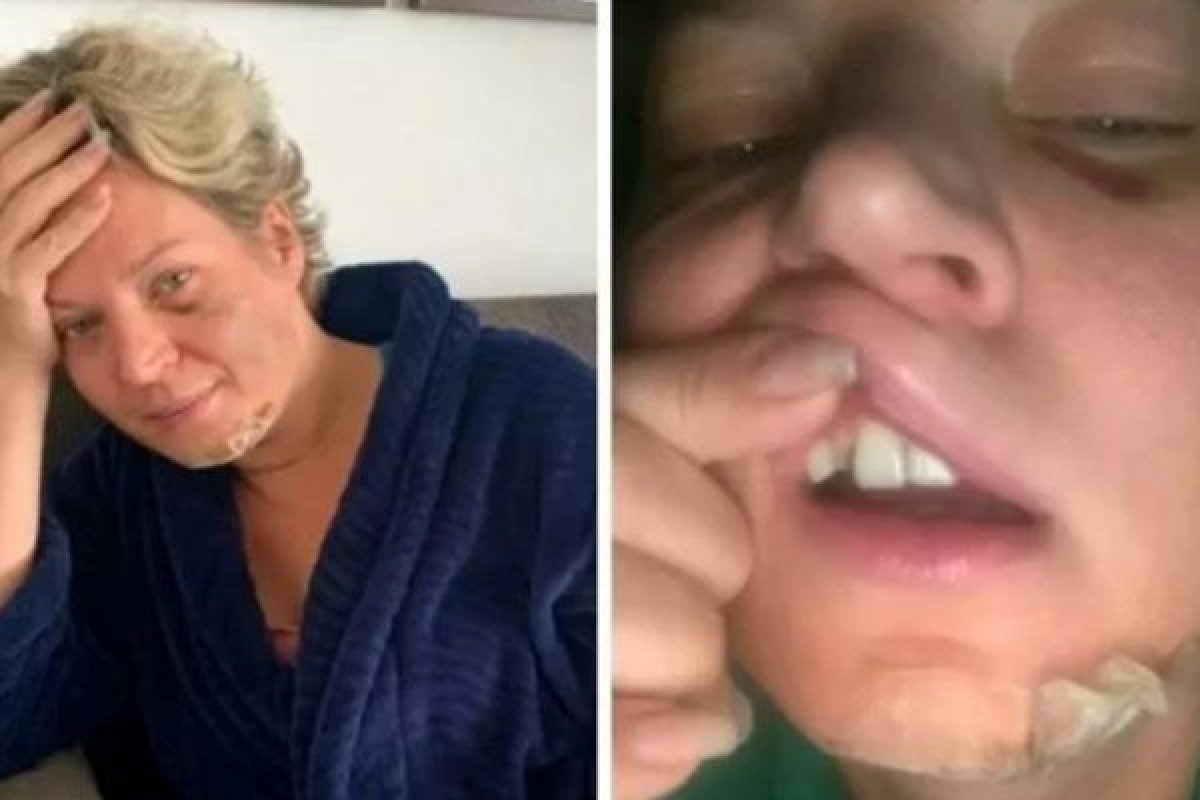 Polícia Civil conclui que Joice Hasselmann sofreu “queda da própria altura”