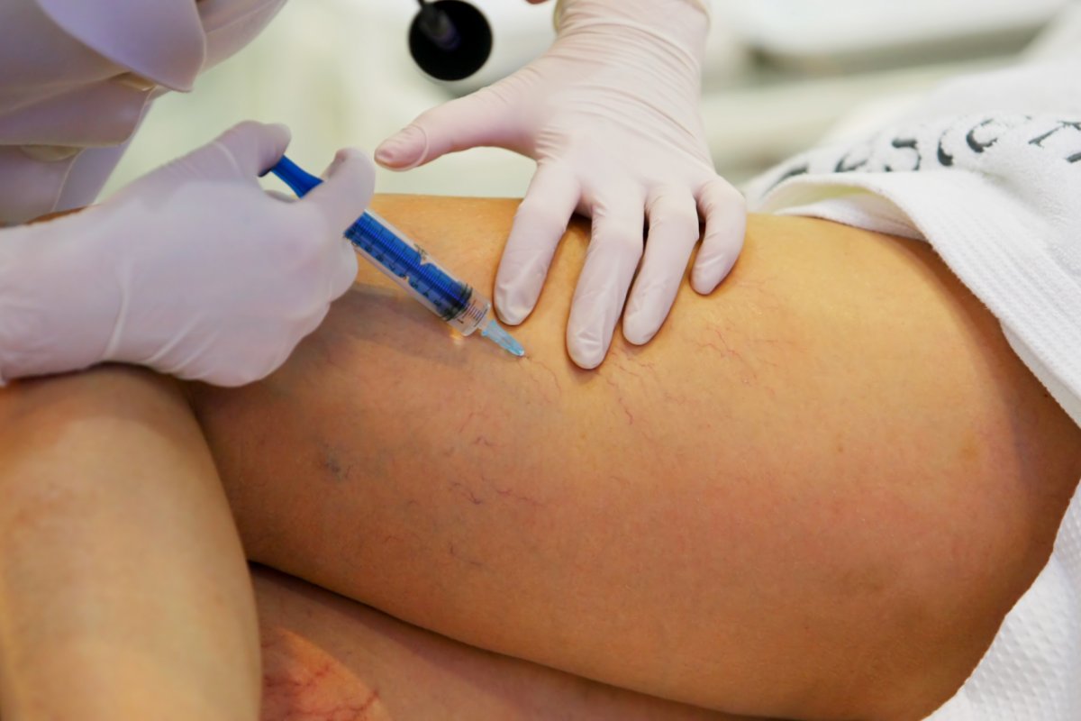 Saiba porque o inverno é o período ideal para tratar varizes