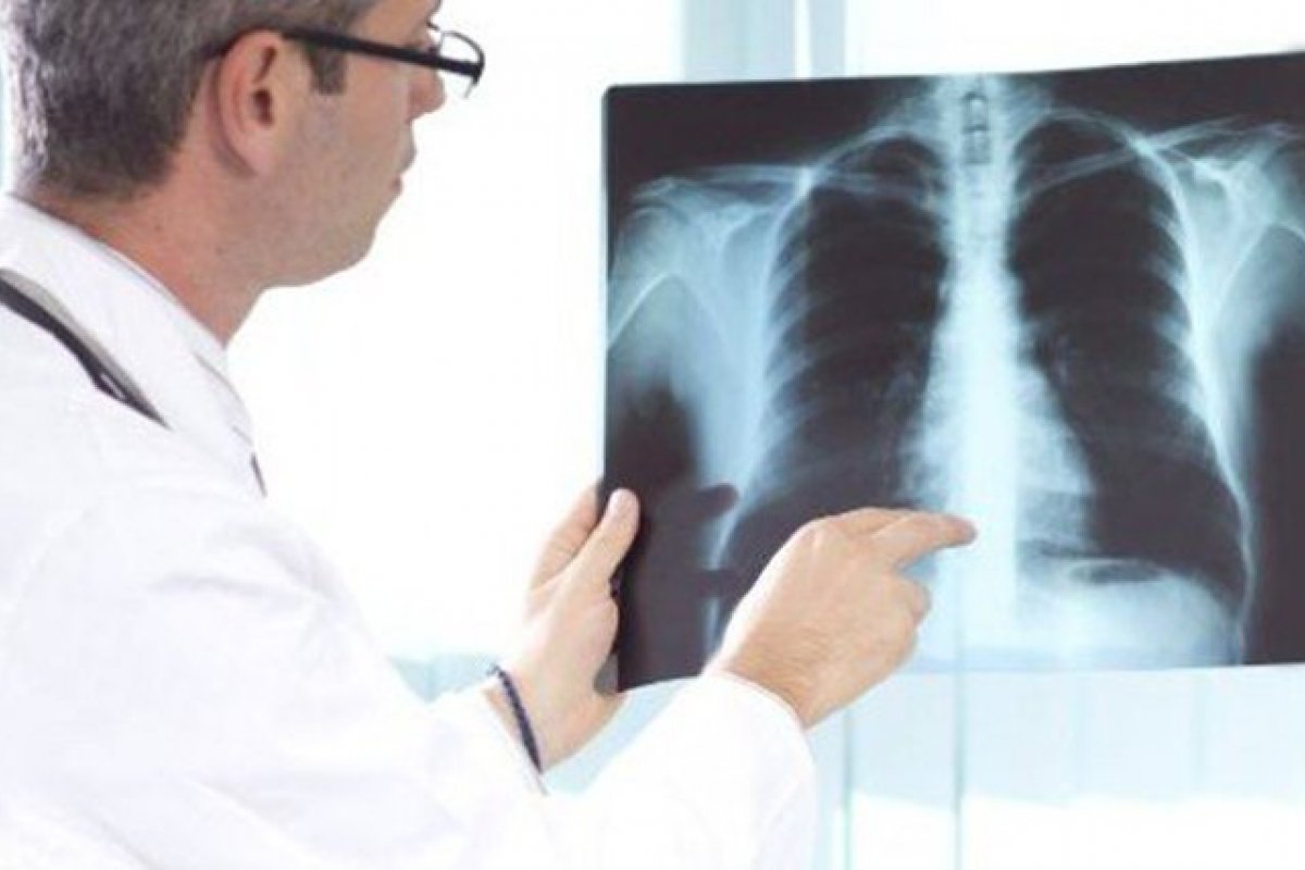 Conscientização sobre câncer de pulmão