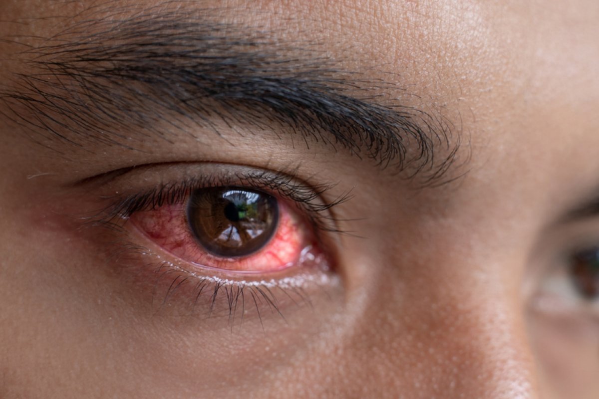 Baixa umidade contribui para o aumento de casos de conjuntivite