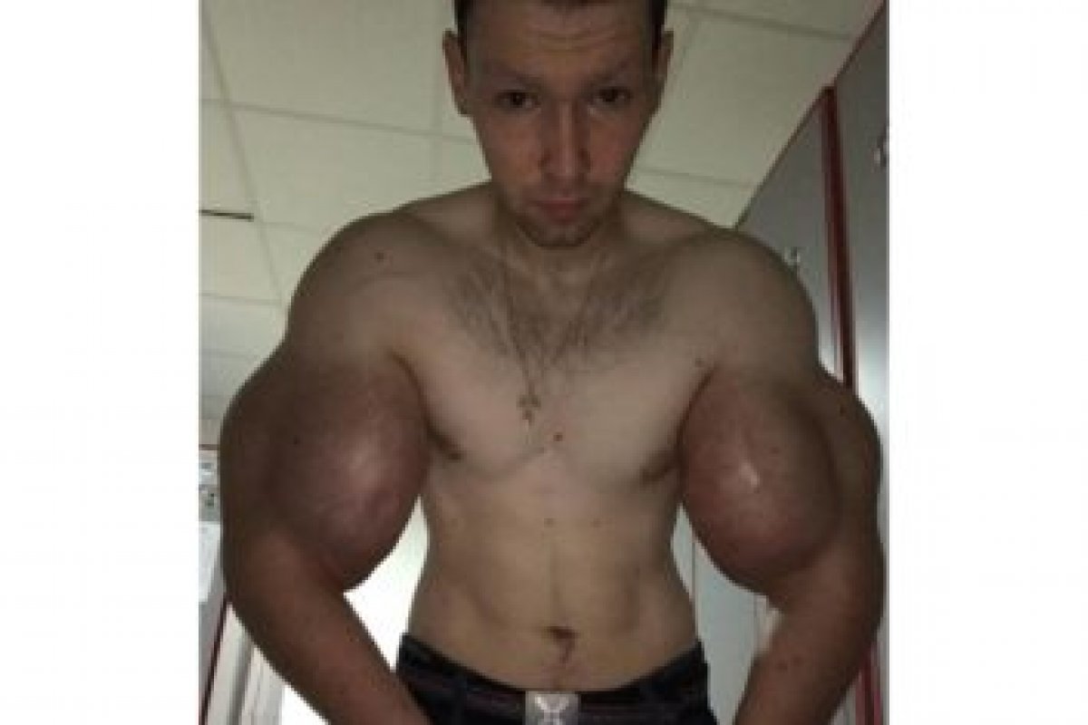 Lutador russo pode morrer após "explosão" de bíceps durante luta