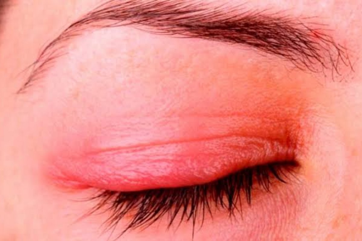 Lágrima com aspecto de espuma pode ser sinal de Meibomite