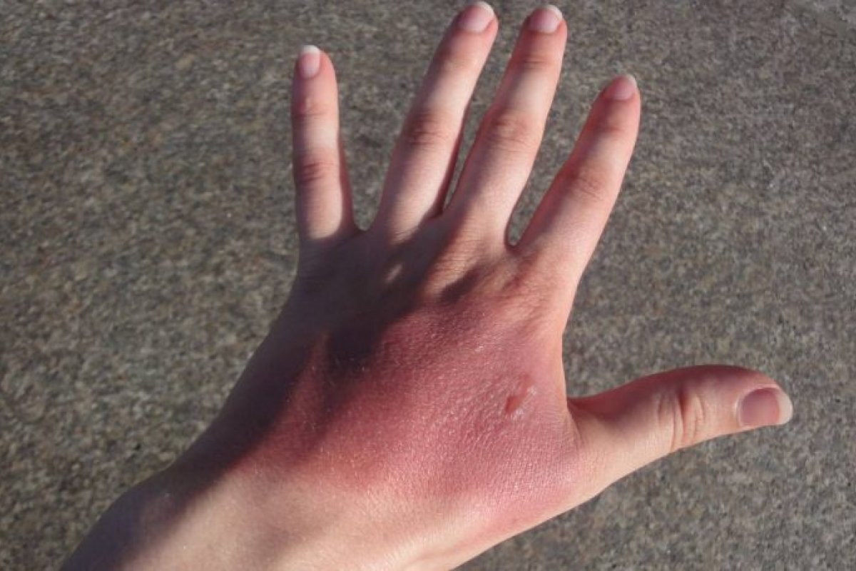 Saiba o que fazer em caso de queimaduras leves ou agravadas