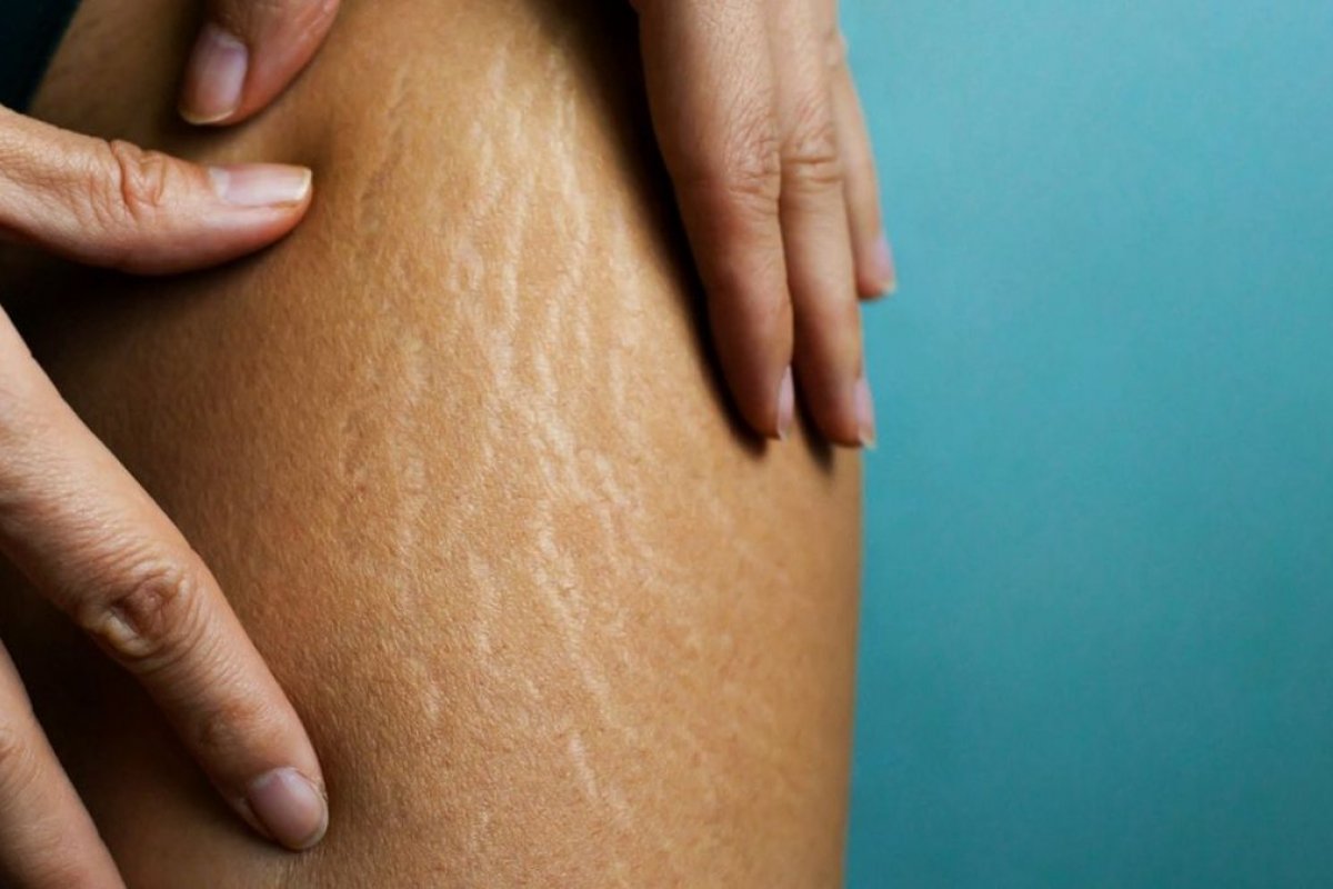 Homens e mulheres se rendem ao tratamento definitivo contra as estrias!