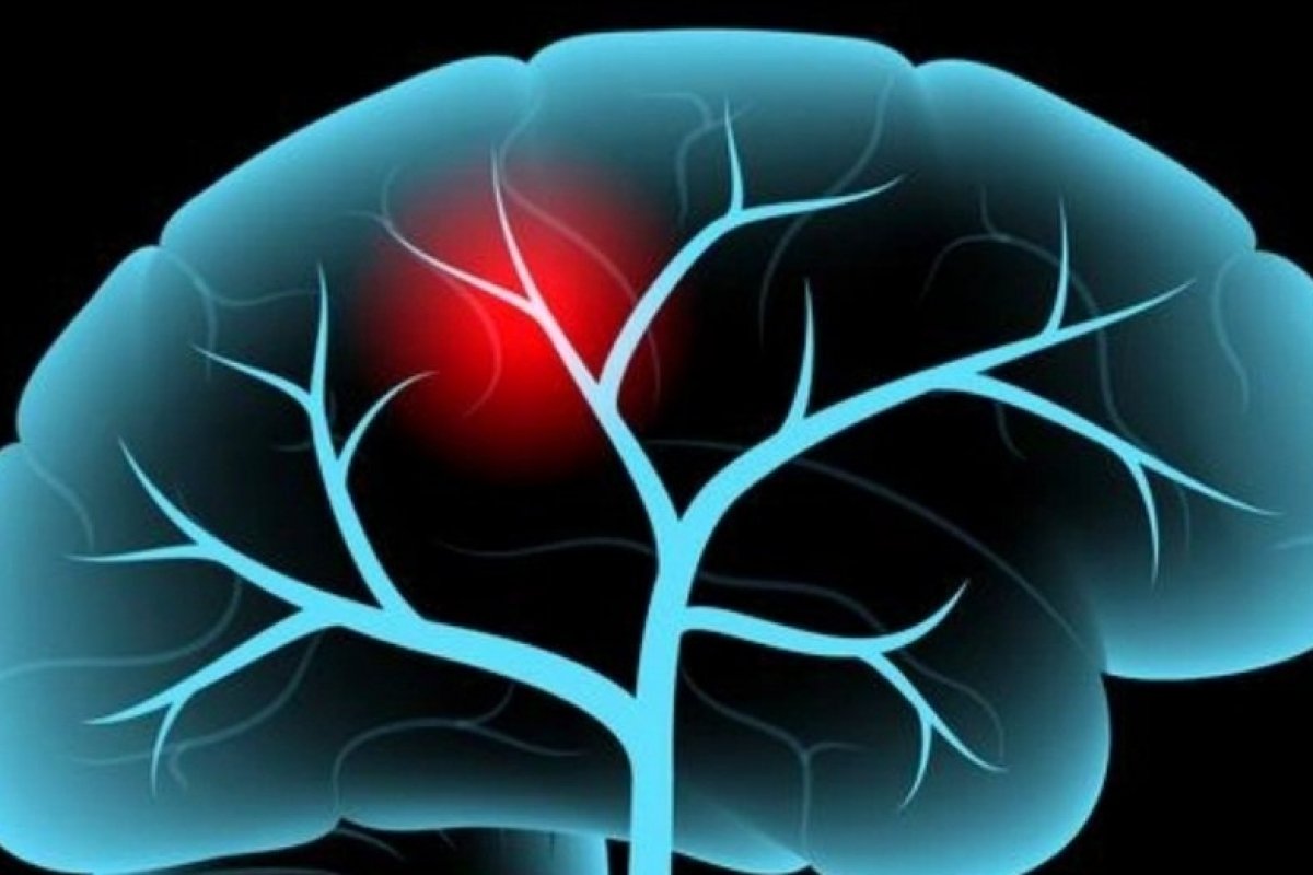 Neurologista alerta sobre aumento de casos de AVC em jovens