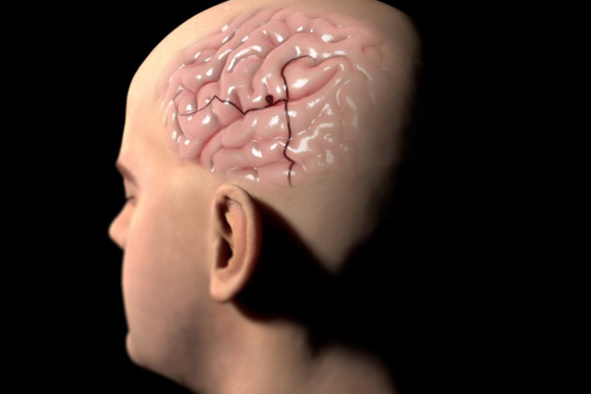 Cientistas descobrem causas do avanço do Alzheimer no cérebro