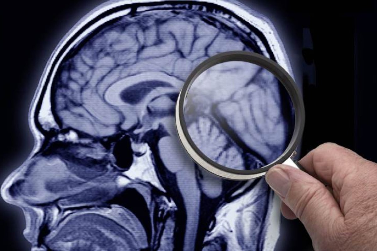 Número de famílias afetadas por Alzheimer pode triplicar até 2050, aponta AC Immune