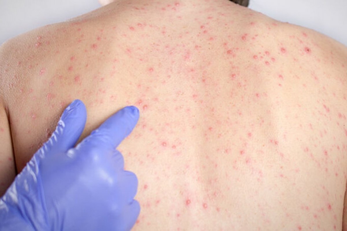 Governo anuncia surto de sarampo na Bahia