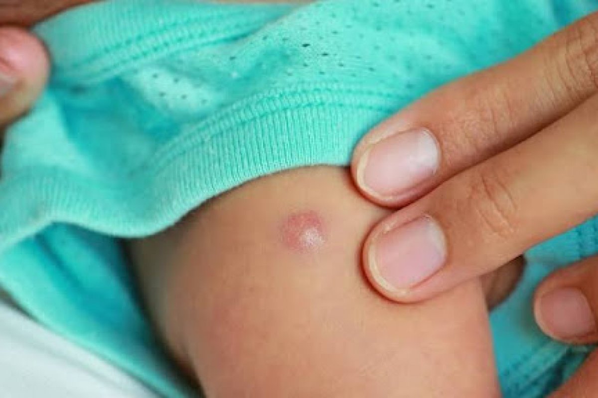 Postos de saúde do oeste baiano estão sem vacina BCG para recém-nascidos