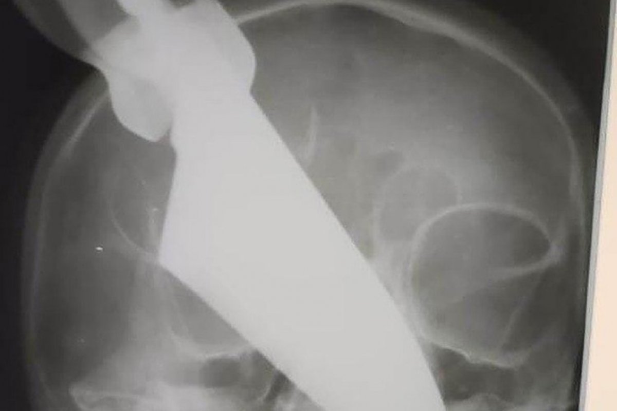 Russa sobrevive a facada no rosto; ela foi agredida pelo marido