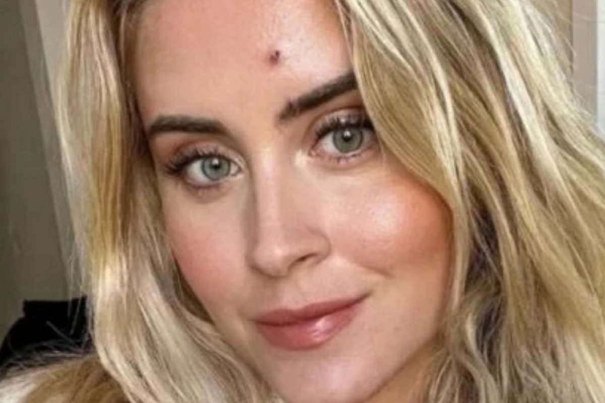 Alerta: Blogueira  descobre que espinha no rosto era um câncer raro